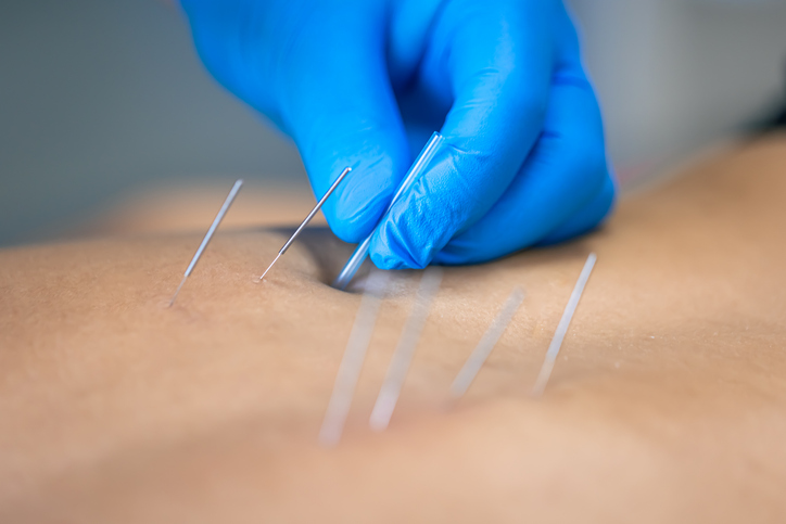 « Dry needling » : pour soulager la douleur et faciliter la récupération 